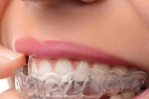 Aligners
