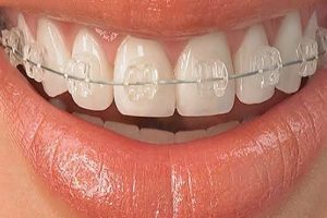Ceramic braces