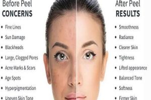 Chemical peels