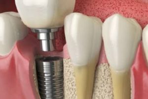 Implants