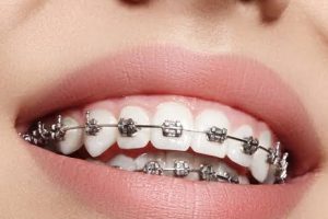 Metal Braces