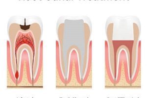 Root canal