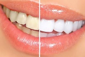 Teeth Whitening